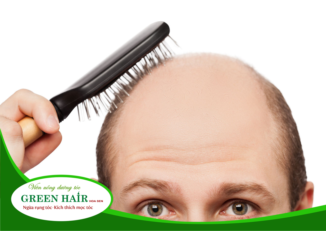 Nam giới thường gặp phải tình trạng rụng tóc di truyền cao hơn nữ giới