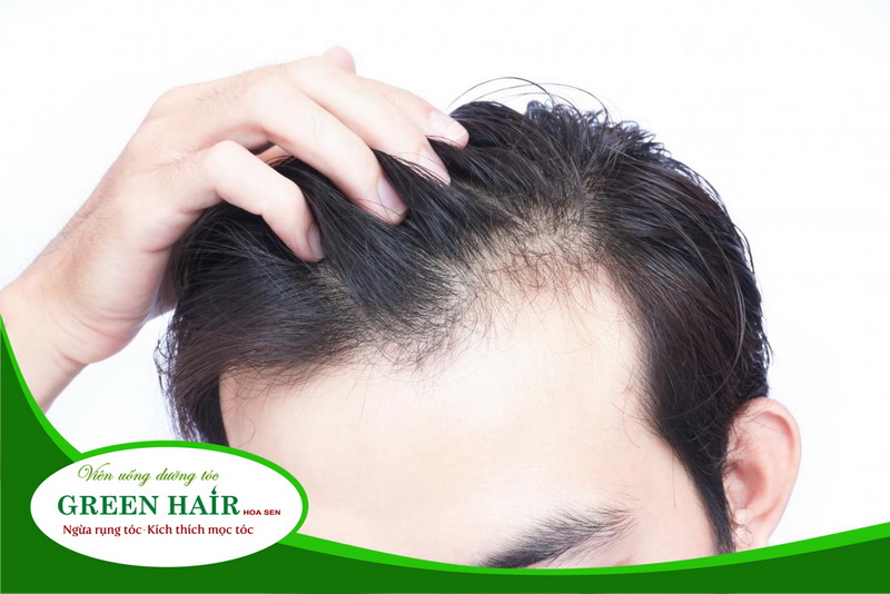 Đa số nam giới đều bị mắc chứng rụng tóc di truyền